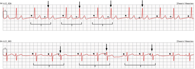 An Open-Access Arrhythmia Database of Wearable Electrocardiogram | Journal  of Medical and Biological Engineering