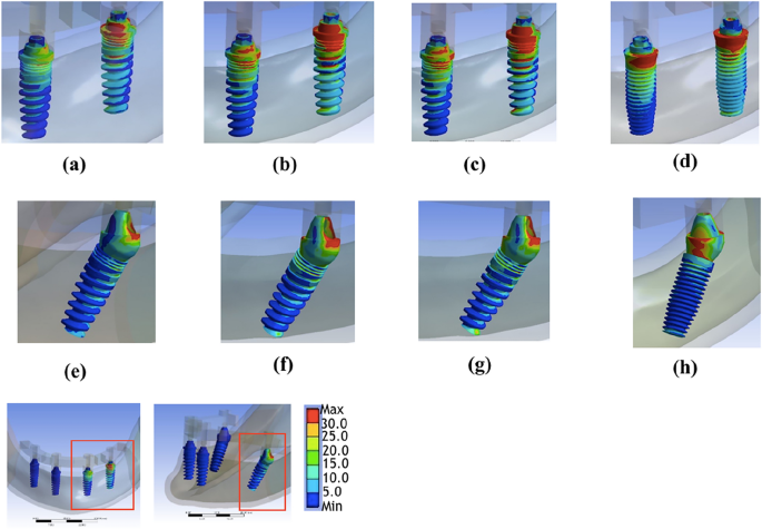 Biomechanical comparison of different prosthetic materials and posterior  implant angles in all-on-4 treatment concept by three-dimensional finite  element analysis