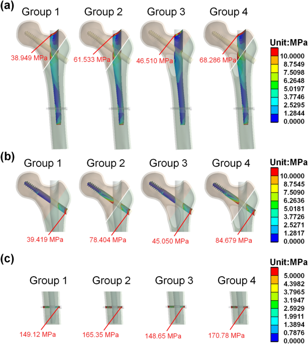 PDF] Modified Short Proximal Femoral Nail for Intertrochanteric Fractures  of Femur in Indian Patients-our Experience | Semantic Scholar