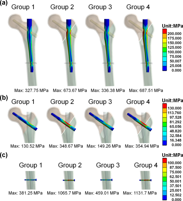 Wedge Effect in Trochanteric Fractures/ IT fractures/ Proximal femur  fractures - YouTube