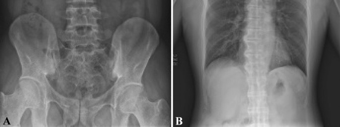 Simplified Ankylosing Spondylitis Disease Activity Score (SASDAS) Versus  ASDAS: A Post Hoc Analysis of a Randomized Controlled Trial