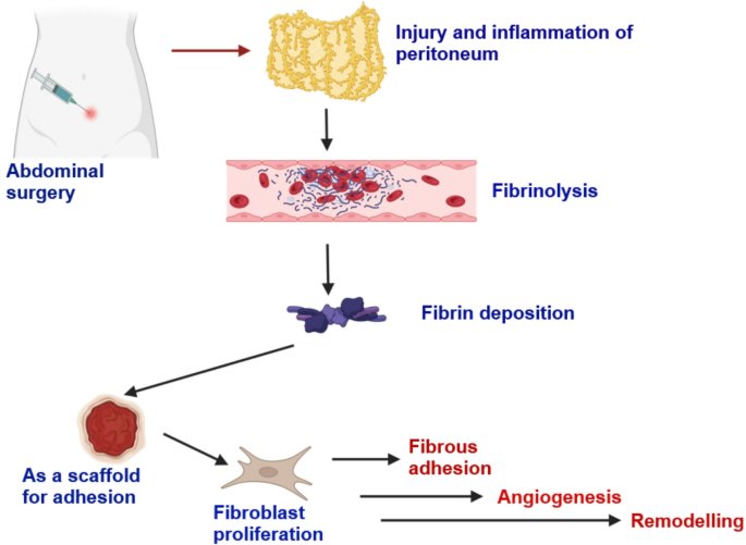 liposomal glutathione and bloating ncbi Natural Products Biomaterial Strategies for Preventing Post-Surgical Adhesions: Emerging Anti-Fibrotic Agents and Mechanistic Insights | Regenerative Engineering and Translational Medicine NEW! Ryxskin Kenpaku Bijin Format:Vial 50mg skincare