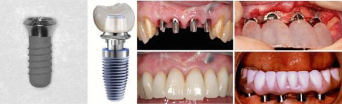 Insertion of the implant into the 4D lodge. The implant lies