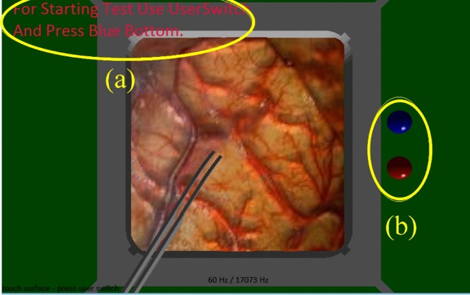 Real-time simulation of electrocautery procedure using meshfree