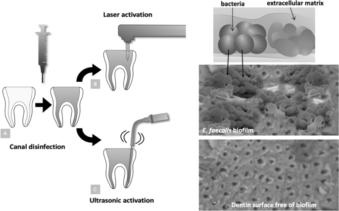 Root Canal Disinfection Using Highly Effective Aggregation-Induced