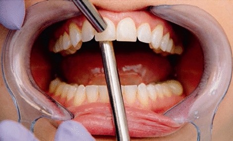 Clinical diagnosis of pulpally involved teeth | Periodontal and Implant  Research