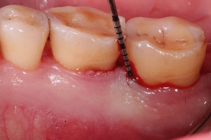 can i take glutathione while taking doxycycline The role of hyaluronic acid in the treatment of periodontal disease: a  systematic review | Periodontal and Implant Research
