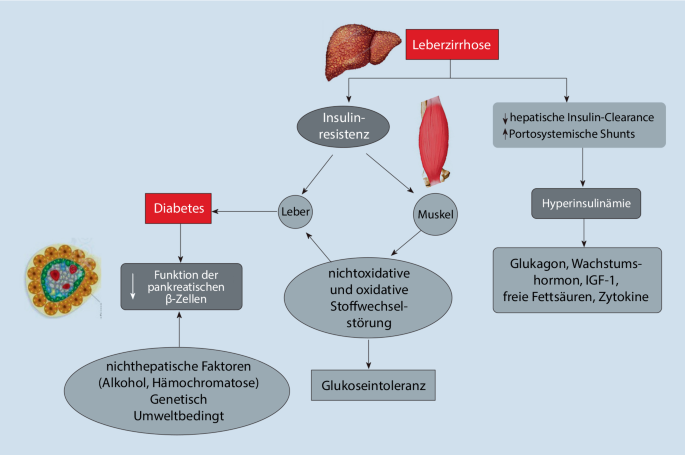 Der hepatogene Diabetes – aktueller Stand der Diagnostik und Therapie |  Journal für Endokrinologie, Diabetologie und Stoffwechsel