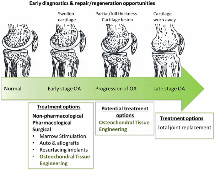 Osteochondral tissue repair in osteoarthritic joints: clinical challenges  and opportunities in tissue engineering | Bio-Design and Manufacturing