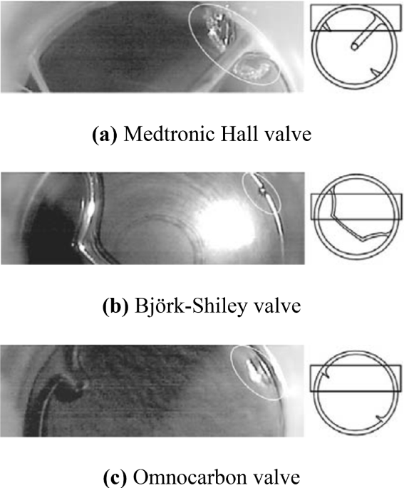 Cavitation energy breaks the blood clot into small pieces in an