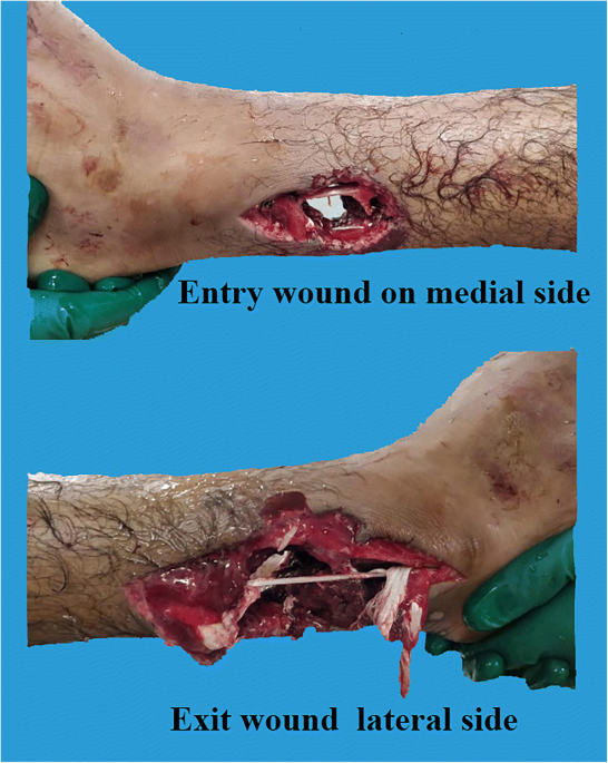 Early Wound Cover of Gunshot Injury to the Leg with Free Composite  Anterolateral Thigh Flap: a Case Report | SN Comprehensive Clinical Medicine
