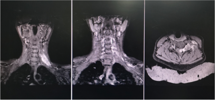 metastatic melanotic peripheral nerve sheath sarcoma symptoms Interosseous Malignant Tumor of the Sacrum Treated With an Innovative Reconstruction Technique Peripheral nerve tumors - Symptoms