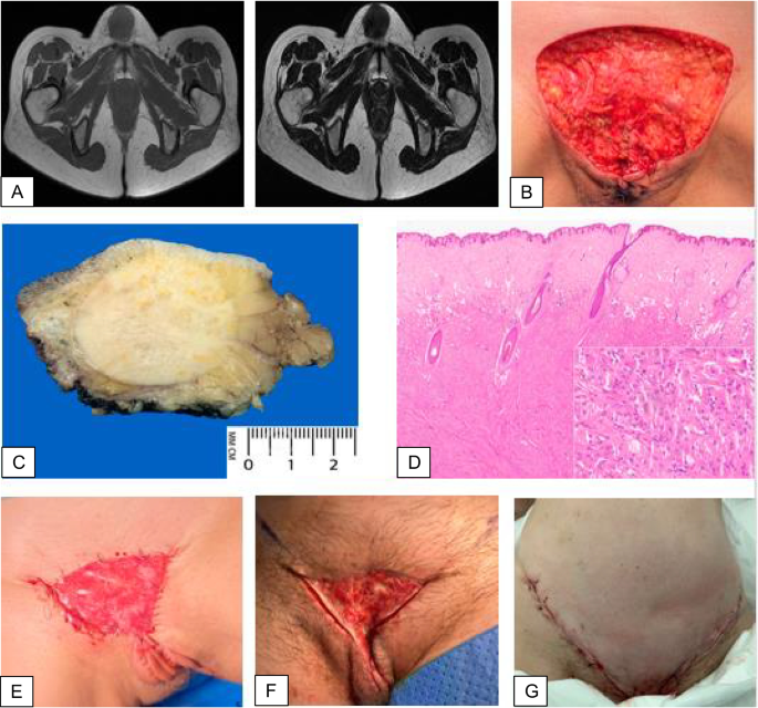A Rarely Seen Granular Cell Tumor of the Mons Pubis—a Case Report