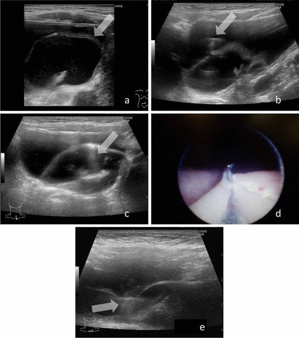 Simultaneous Use of Transabdominal Ultrasonography in Endoscopic Procedures: Three Case Series