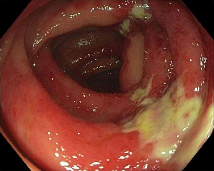 semaglutide and ischemic colitis Colitis: Symptoms & Treatment Are you familiar with ischemic