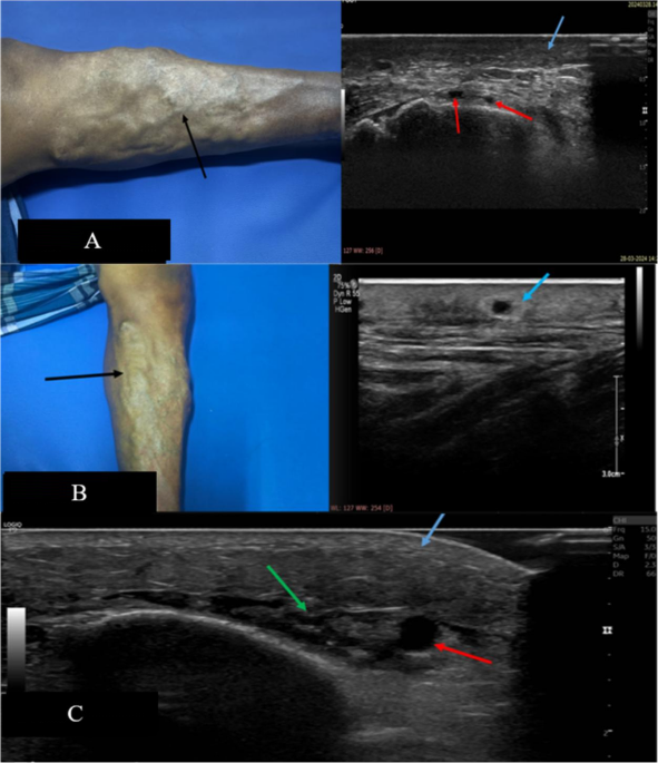 High-Resolution Ultrasonography in the Evaluation of Cutaneous Changes in Chronic Venous Disease: Association with CEAP Clinical Classification - SN Comprehensive Clinical Medicine