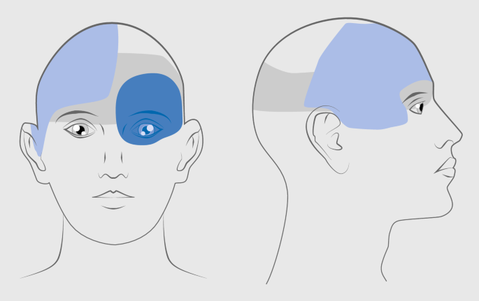 Differenzialdiagnose von Kopf- und Gesichtsschmerzen | DGNeurologie
