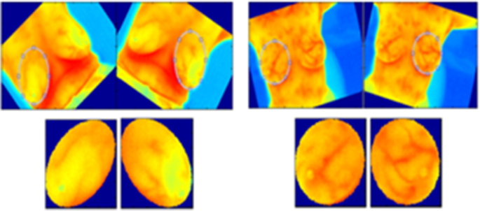 Automatic segmentation of region of interest for breast thermographic image  classification