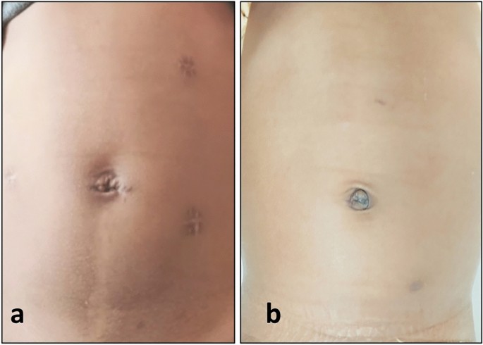 Does port type or wound closure technique influence cosmetic