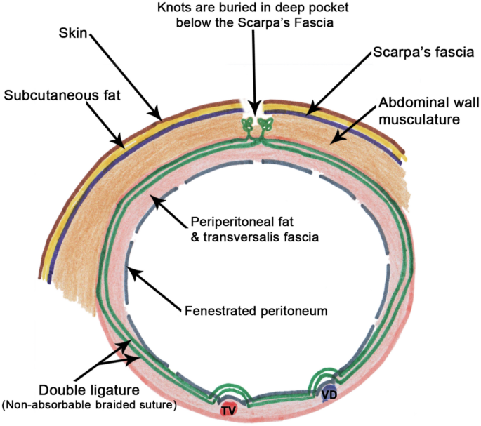 Transversalis fascia suture reinforcement may facilitate the performance of  electrospun P(LLA-CL) nanoscale fibrinogen mesh in inguinal hernia repair:  a prospective single-center cohort study