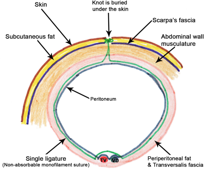 The application of single-port laparoscopic percutaneous internal