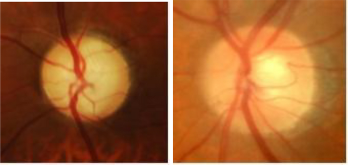 Optic Disc Staging Systems Effective in Grading Advanced Glaucoma