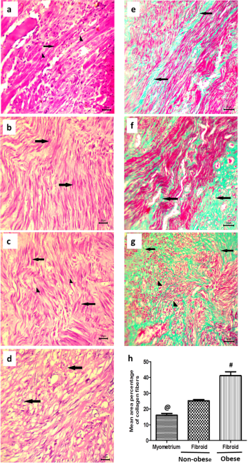 Increased Expression of Fibroblast Activation Protein is Associated with  Autophagy Dysregulation and Oxidative Stress in Obese Women with Uterine  Fibroids | Reproductive Sciences