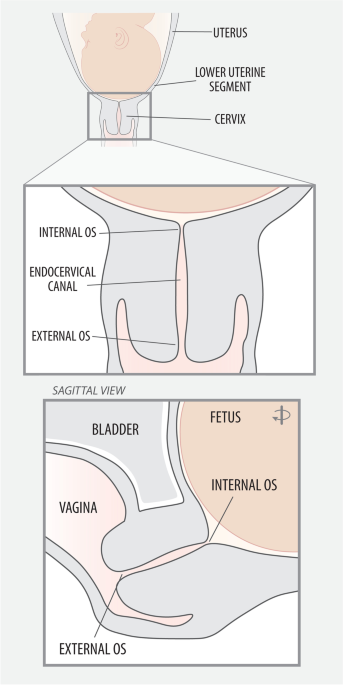 The Pathophysiology of Labor Dystocia: Theme with Variations | Reproductive  Sciences