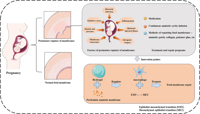 Frontiers in the Etiology and Treatment of Preterm Premature Rupture of  Membrane: From Molecular Mechanisms to Innovative Therapeutic Strategies |  Reproductive Sciences