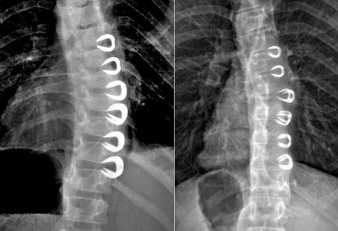 Continued vertebral body growth in patients with juvenile idiopathic  scoliosis following vertebral body stapling | Spine Deformity
