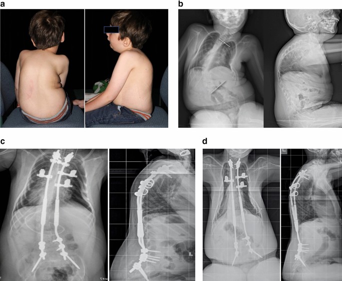 The impact of scoliosis surgery on pulmonary function in spinal muscular  atrophy: a systematic review | Spine Deformity