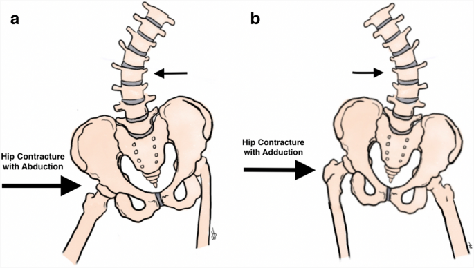 Pelvic obliquity associated with neuromuscular scoliosis in cerebral palsy: كيف يؤدي انزياح الورك إلى ميلان الحوض في الشلل الدماغي؟