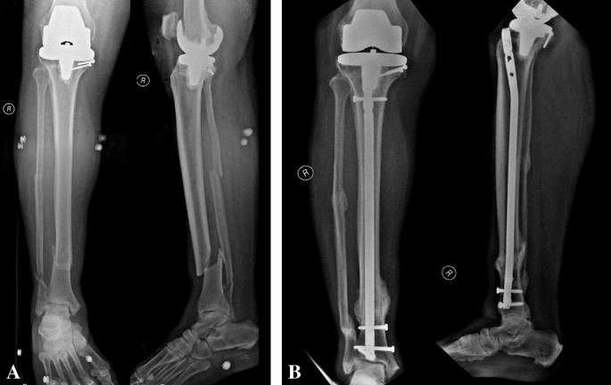 Effectiveness of Nail Dynamization in Delayed Union of Tibial Shaft  Fractures: Relationship Between Fracture Morphology, Callus Diameter, and  Union Rates | Indian Journal of Orthopaedics