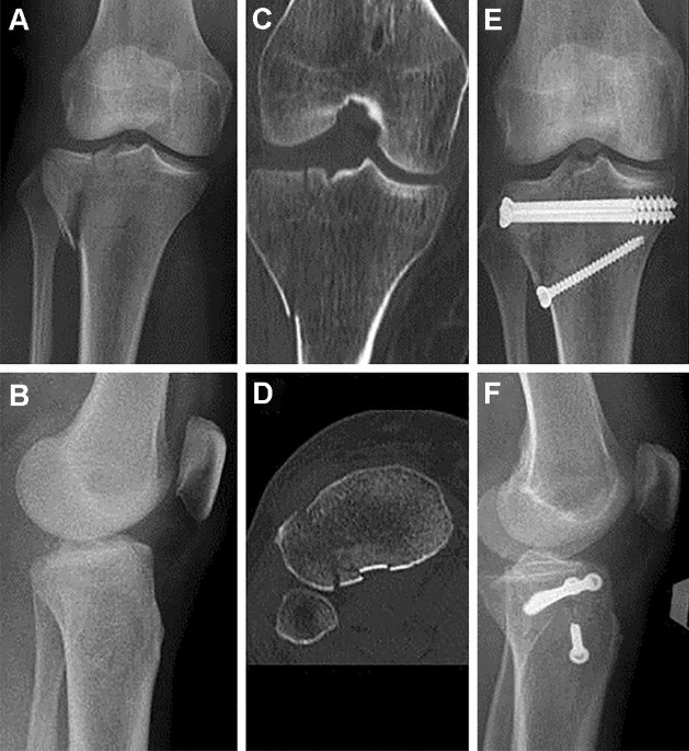 Importance of CT Scan in Predicting the Outcomes of Tibial Plateau Fractures:  A Retrospective Study of 216 Patients over 10 Years' Time | Indian Journal  of Orthopaedics