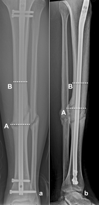 The semi-extended infrapatellar intramedullary nailing of distal tibia  fractures: a randomized clinical trial | Journal of Orthopaedics and  Traumatology | Full Text