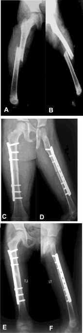 Elastic Stable Intramedullary Nailing for Pediatric Long Bone Fractures:  Experience with 175 Fractures