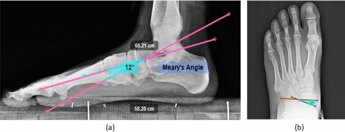 Flexible flatfoot: Foot orthoses and outcomes