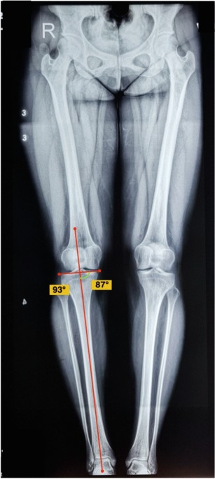 Radiological Evaluation of the Phenotype of Indian Osteoarthritic Knees  based on the Coronal Plane Alignment of the Knee Classification (CPAK)