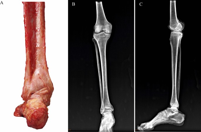 Lateral Malleolar Fracture  Published in Orthopedic Reviews
