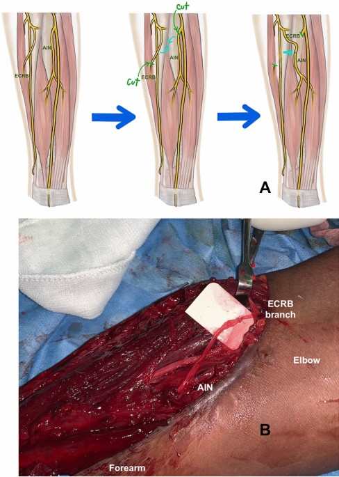 Nerve Damage In The Hand - Golden State Orthopedics & Spine