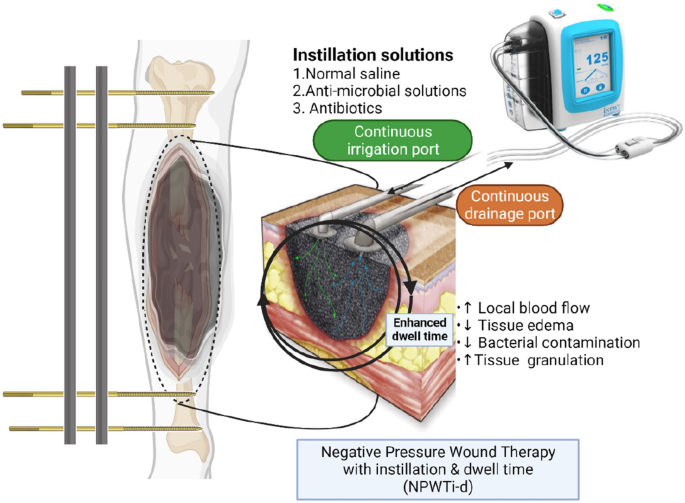 Evolving Role of Negative Pressure Wound Therapy with Instillation and  Dwell Time (NPWTi-d-) in Management of Trauma and Orthopaedic Wounds:  Mechanism, Applications and Future Perspectives
