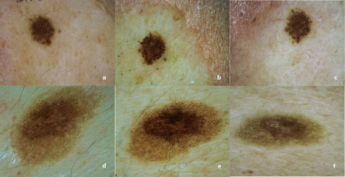 melanotan 2 reddit steroids Love Island generation' skin cancer fear