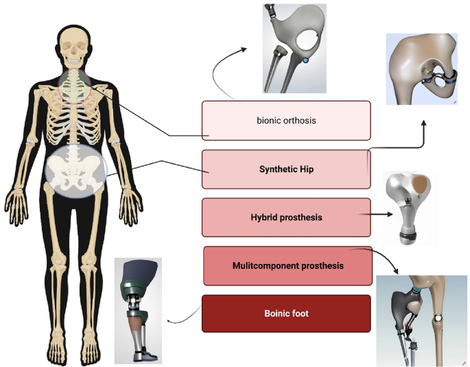 Overcoming Challenges and Innovations in Orthopedic Prosthesis Design: An  Interdisciplinary Perspective | Biomedical Materials & Devices