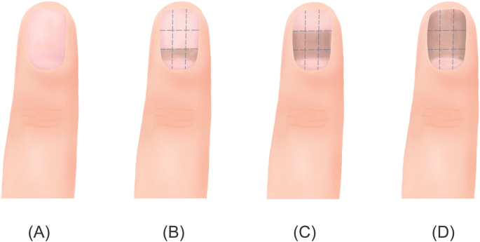 Blue to Slate Gray Discoloration of the Proximal Fingernails | MDedge  Dermatology