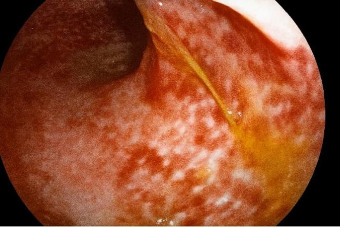 Transient sinus bradycardia complicating acute severe ulcerative colitis a case report and review of the literature