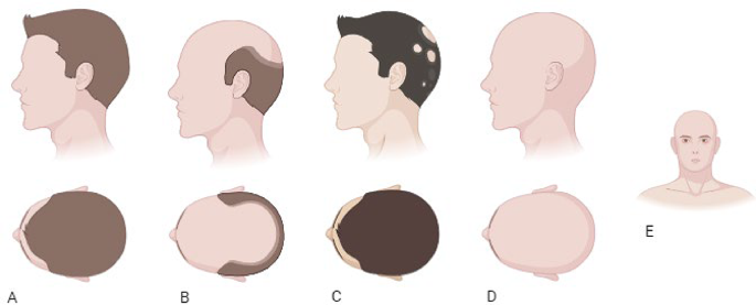 glutathione and alopecia Alopecia areata: a comprehensive review of clinical, immunologic, and  genetic perspectives | Discover Immunity