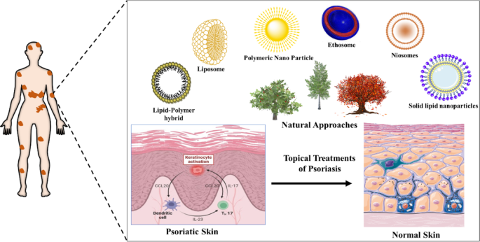 Exploring innovative therapeutic strategies for psoriasis treatment using  bioactive compounds | Discover Pharmaceutical Sciences