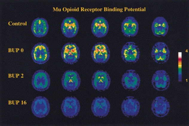 Buprenorphine Induced Changes In Mu Opioid Receptor Availability In Male Heroin Dependent Volunteers A Preliminary Study Neuropsychopharmacology