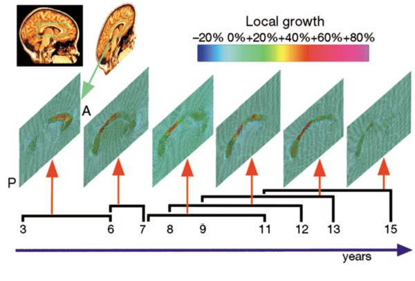 Growth patterns in the developing brain detected by using continuum mechanical tensor maps