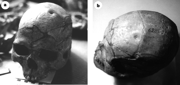 Cranial surgery dates back to Mesolithic | Nature
